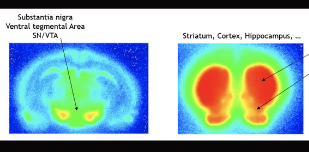 Simultaneous SPECT imaging of neurotransmitter systems in the brain